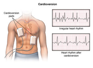 HHW cardioversion