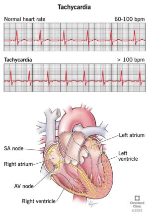 ablation tachycardia2